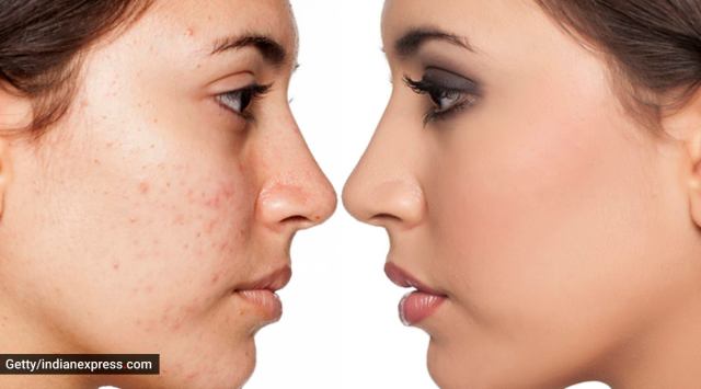 Does Red Light Therapy Help Acne