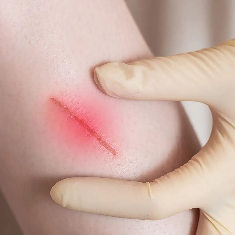 Improving Chronic Wound Healing with LED Phototherapy,prungo